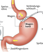 Magenband Schaubild